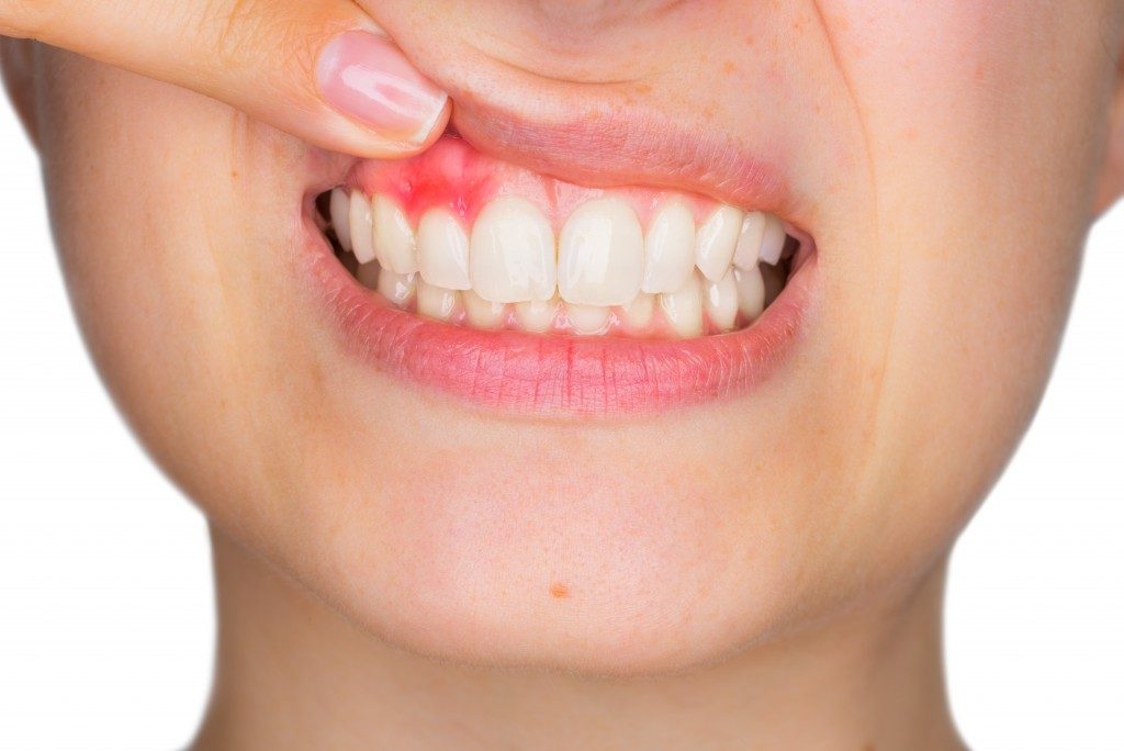 Closeup photo of an infected gum