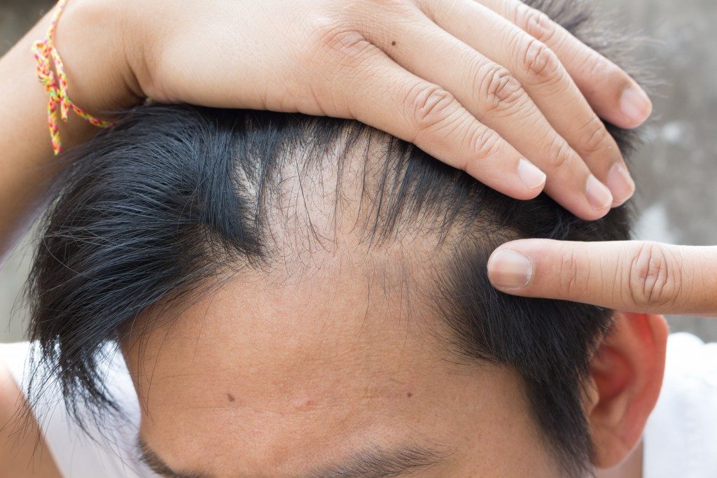 Man pointing bald part of his hair