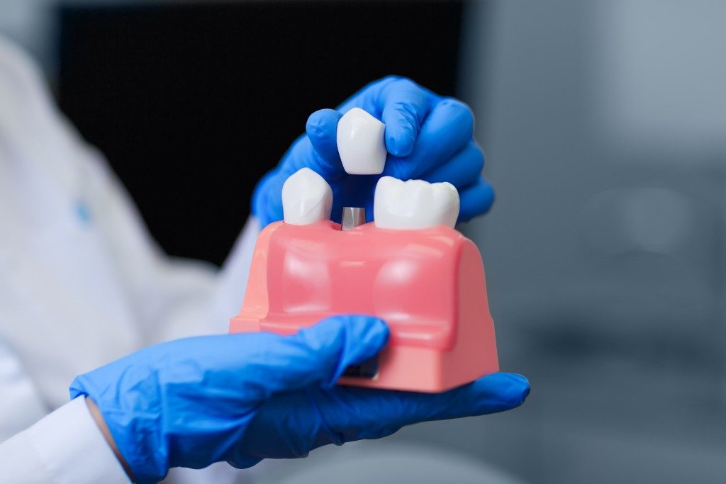 dentist showing a model of dental implant