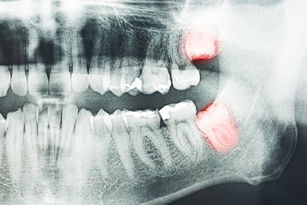xray of molar teeth