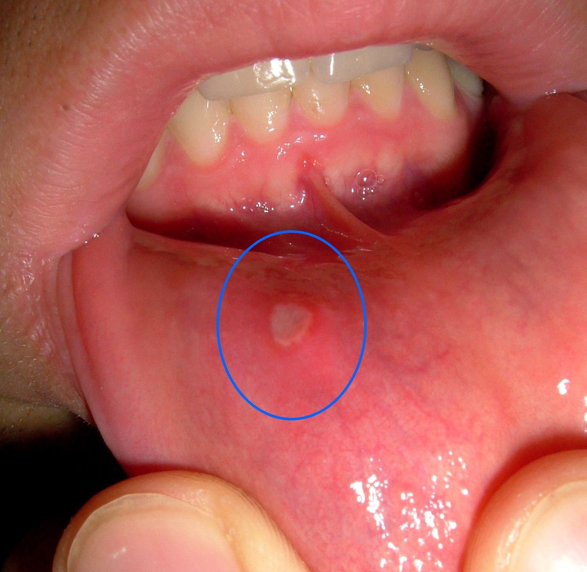 How to Deal with Mouth Ulcers Caused by Metal Braces Reclaiming The