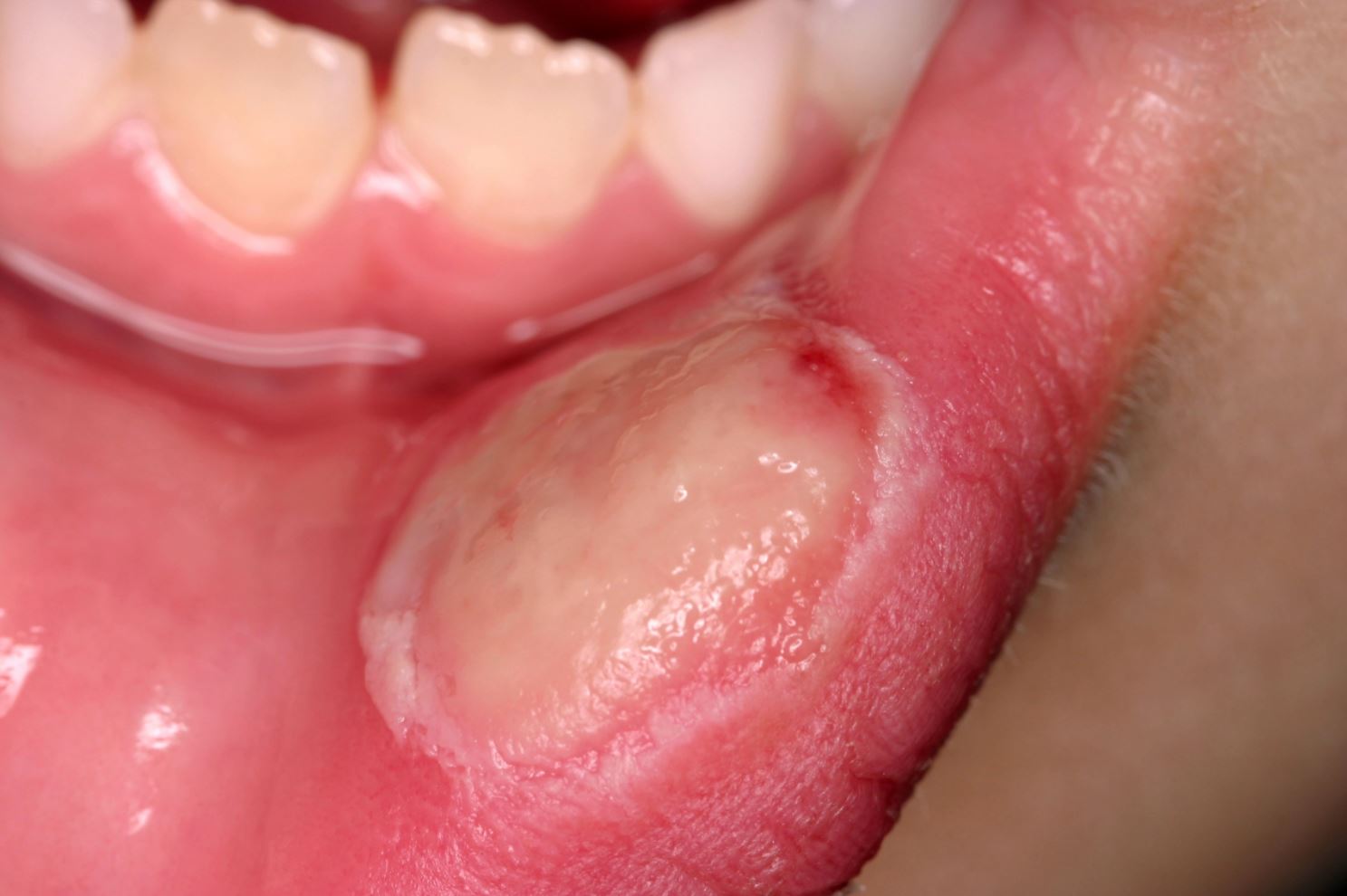 Mouth Ulcer