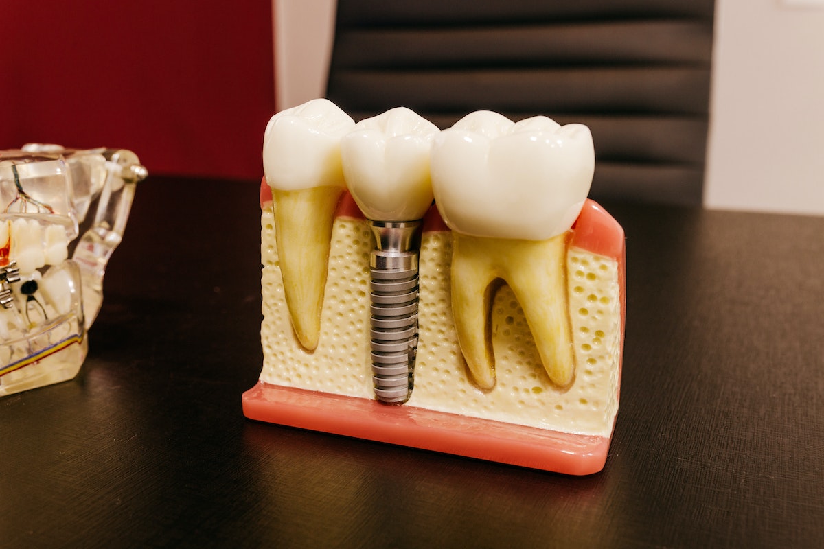 dental implants
