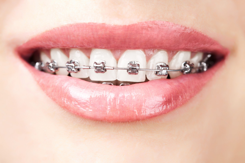 Teeth with dental braces