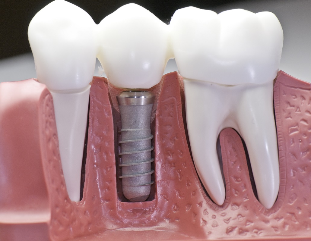 oral implant model