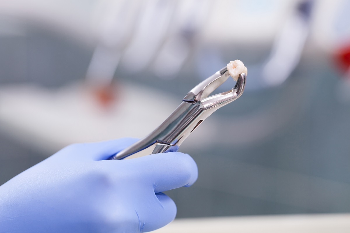 Extracted tooth held by dentist